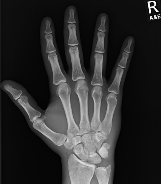 X-ray image of a human hand showing bones in detail.
